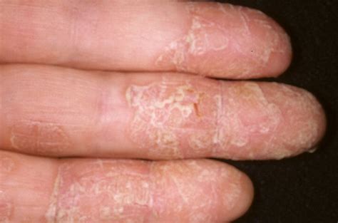 Dry Eczema On Hands Pictures 475 Photos And Images