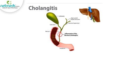 Cholangitis Causes Symptoms And Treatment