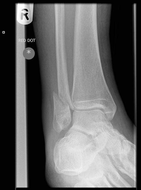 Ankle Fracture Archives Emergency Medicine Education