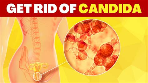 How To Treat Candida Naturally In Steps Youtube