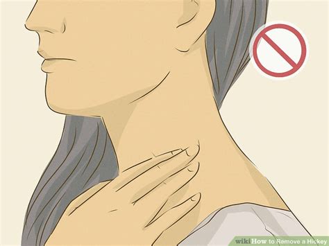 How To Remove Kiss Mark On Neck Fast Howto Techno