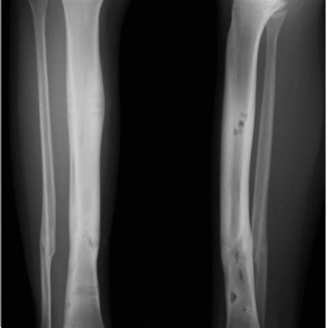 Postoperative Radiographs Of The Tibial Shaft Fracture Treated Using