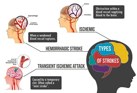 Types Of Strokes