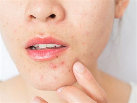 What Causes Acne Around The Mouth The Wiire