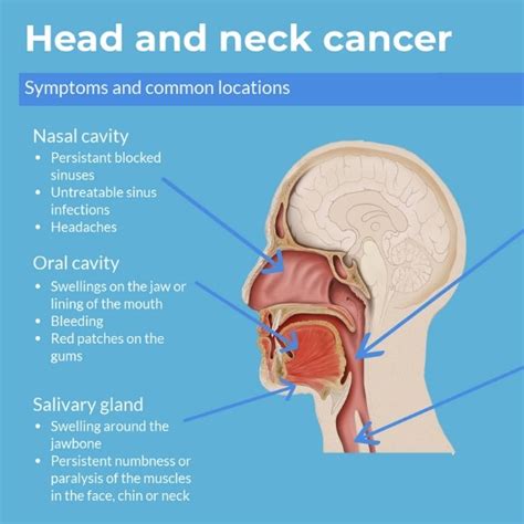 Head And Neck Cancer Diagram