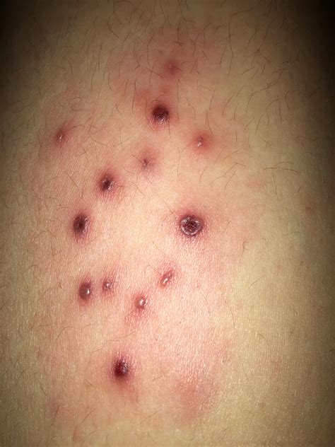 Bumps On My Thigh That Are Painful My Leg Feels Sore Diagnoseme