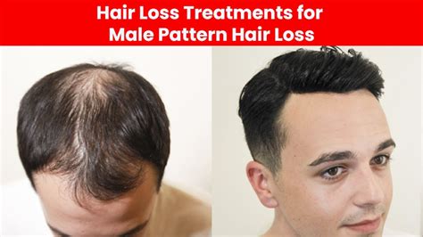 Hair Loss Treatment For Men In Male Pattern Baldness Hair Loss