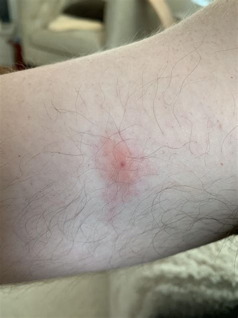 Help Identifying Bugspider Bite Somewhat Itchy And This Is 12 Hours