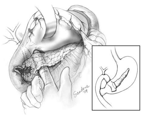 Surgical Exposure Of Ampulla Duct And Pancreatic Head Disruption For