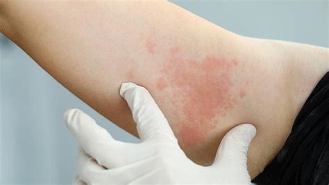 Entenda o que é a alergia ao suor seus sintomas e tratamento