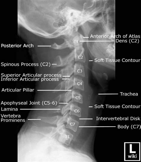 Cervical Spine Radiographic Anatomy Radiologypicscom Radiology