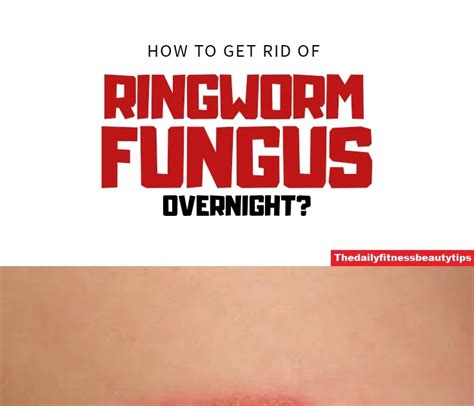 We did not find results for: How To Get Rid Of Ringworm Permanently?
