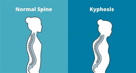 Kyphosis Causes Symptoms And Treatments