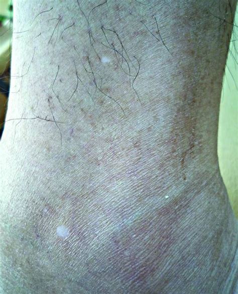 What Is Your Diagnosis Idiopathic Guttate Hypomelanosis Mdedge