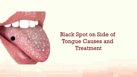 Black Spot On Side Of Tongue Causes And Treatment