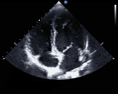 Focused Cardiac Ultrasonography Offers Greater Sensitivity For
