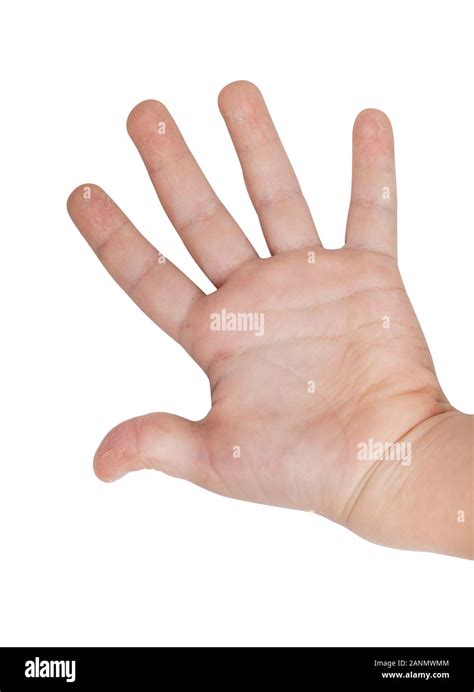 The Hand Of A Child With Scarlet Fever The Initial Stage Of