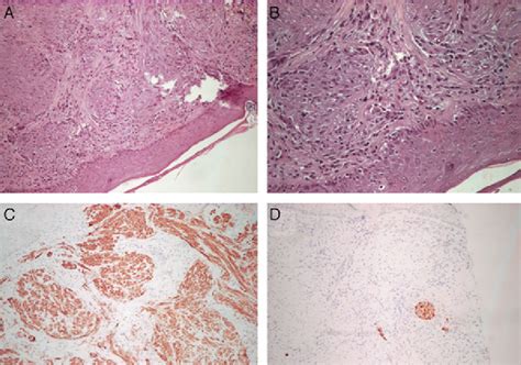 Ulcerated Congenital Tumor Actas Dermo Sifiliográficas