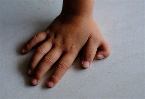 Babies Born With Extra Fingers And Toes Causes And Treatment