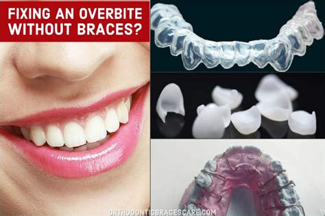 Discover 3 ways you can straighten your smile with cosmetic dentistry procedures in tulsa, ok. How To Fix An Overbite Without Braces | Orthodontic Braces Care