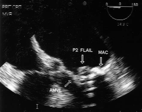 Iatrogenic Aortic Incompetence After Mitral Valve Replacement Journal