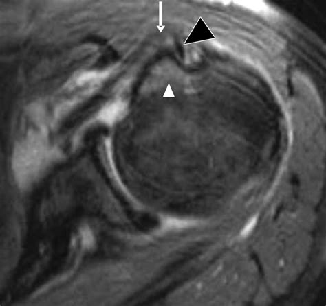 Abnormalities On Mri Of The Subscapularis Tendon In The Presence Of A