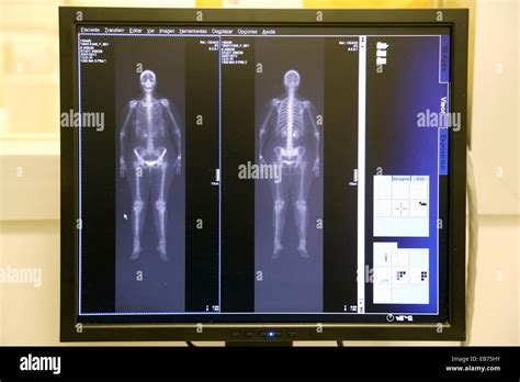 Bone Scintigraphy Image Scintigraphy Is A Form Of Diagnostic Test Used