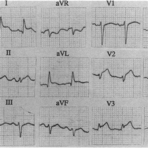Electrocardiogram Demonstrating St Segment Elevation In Leads I Ii