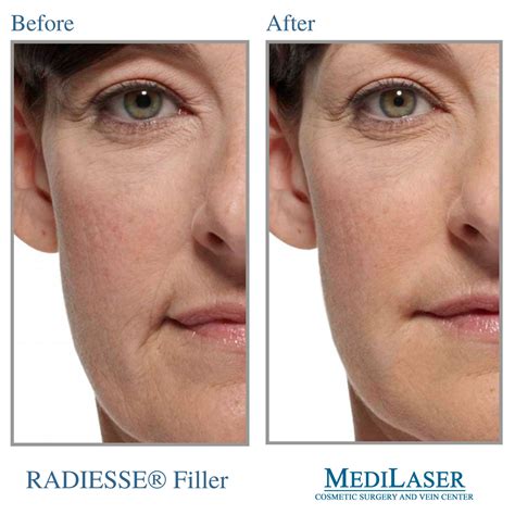 radiesse® before and after medilaser surgery and vein center