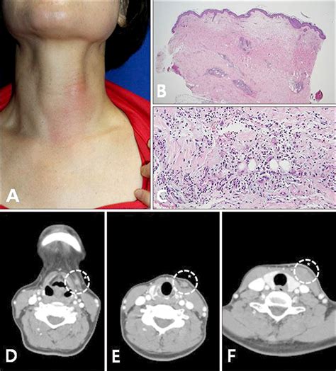 Fistula Of The Submandibular Gland Presenting As A Painful Mass In The