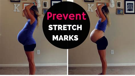 How To Get Rid Of Stretch Marks Without Cream Or Surgery Before And After