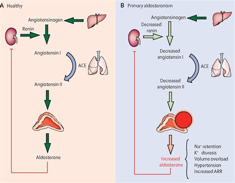 Diagnosis And Treatment Of Primary Aldosteronism The Lancet Diabetes