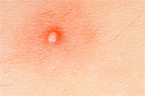 Lumps And Bumps On Skin Explained Best Health Canada