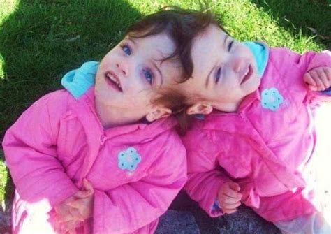 Real Answers To Questions Youve Always Had About Conjoined Twins