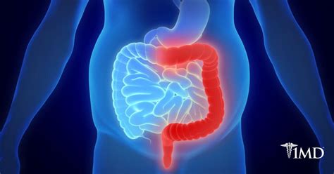 Early Signs Of Bowel Disorder Recognize Disease