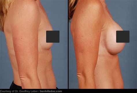Cosmetic Surgery Before And After Pictures Liposuction Tummy Tuck