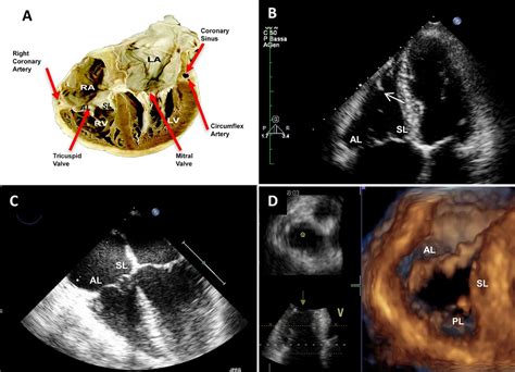 Multimodality Imaging Of The Tricuspid Valve With Implication For