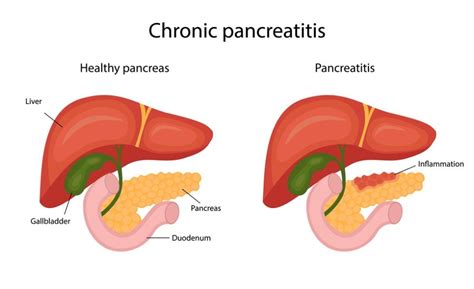 Life Expectancy Of Chronic Pancreatitis With Causes And Symptoms