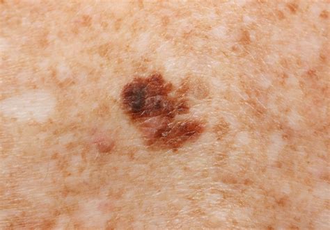 Superficial Spreading Melanoma Pictures Pictures Photos
