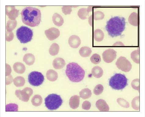 Peripheral Blood Smear Showed The Presence Of Atypical
