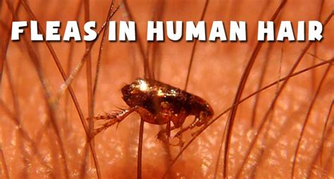 Fleas In Human Hair Symptoms And How To Stop This Menace