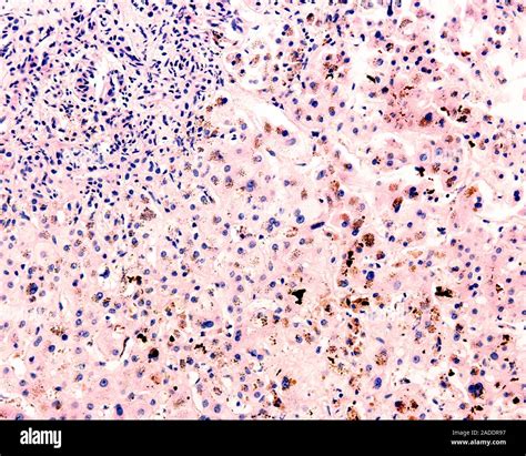Light Micrograph Of A Liver Needle Biopsy In Haemochromatosis The