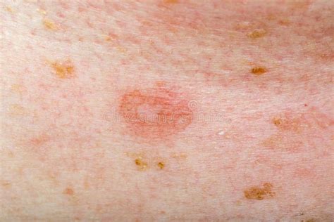 Candida Infection On Human Skin Stock Image Image Of Health Disease