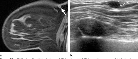 Figure 1 From Distinguishing Breast Skin Lesions From Superficial