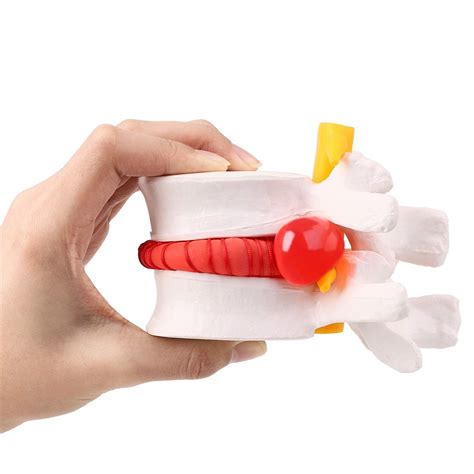 Anatomical Lumbar Disc Herniation Demonstration Model For Human Spine Hot Sex Picture