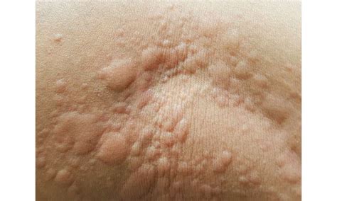 What Are Hives The Common Skin Condition That Gives You Itchy Red