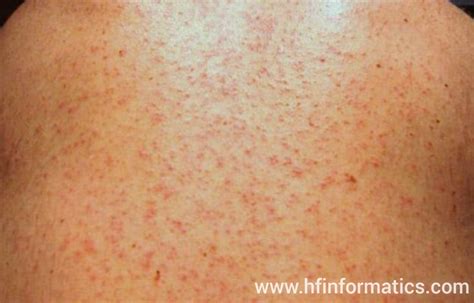 Maculopapular Rash Pictures Symptoms Causes And Treatment