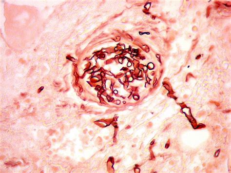 Mucormycosis, also known as black fungus, is a serious fungal infection, usually in people with reduced ability to fight infections. Mucormicose