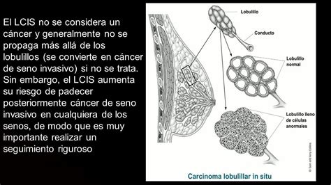 Carcinoma Ductal In Situ Flashcards