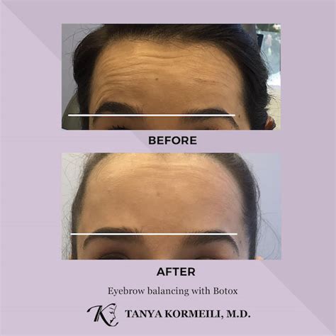 Best Wrinkles Treatment Los Angeles And Santa Monica Dr Tanya Kormeili